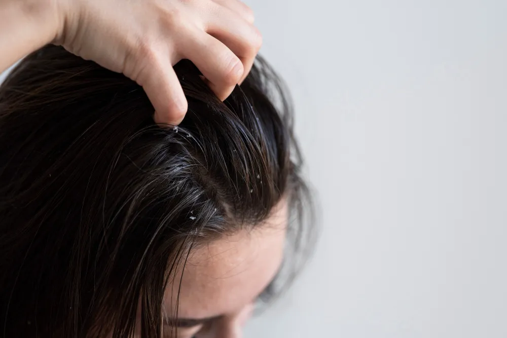 Dry Scalp