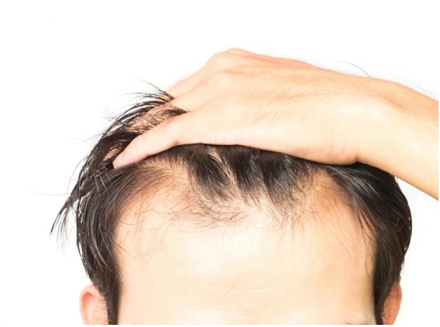Tips to prevent hair loss