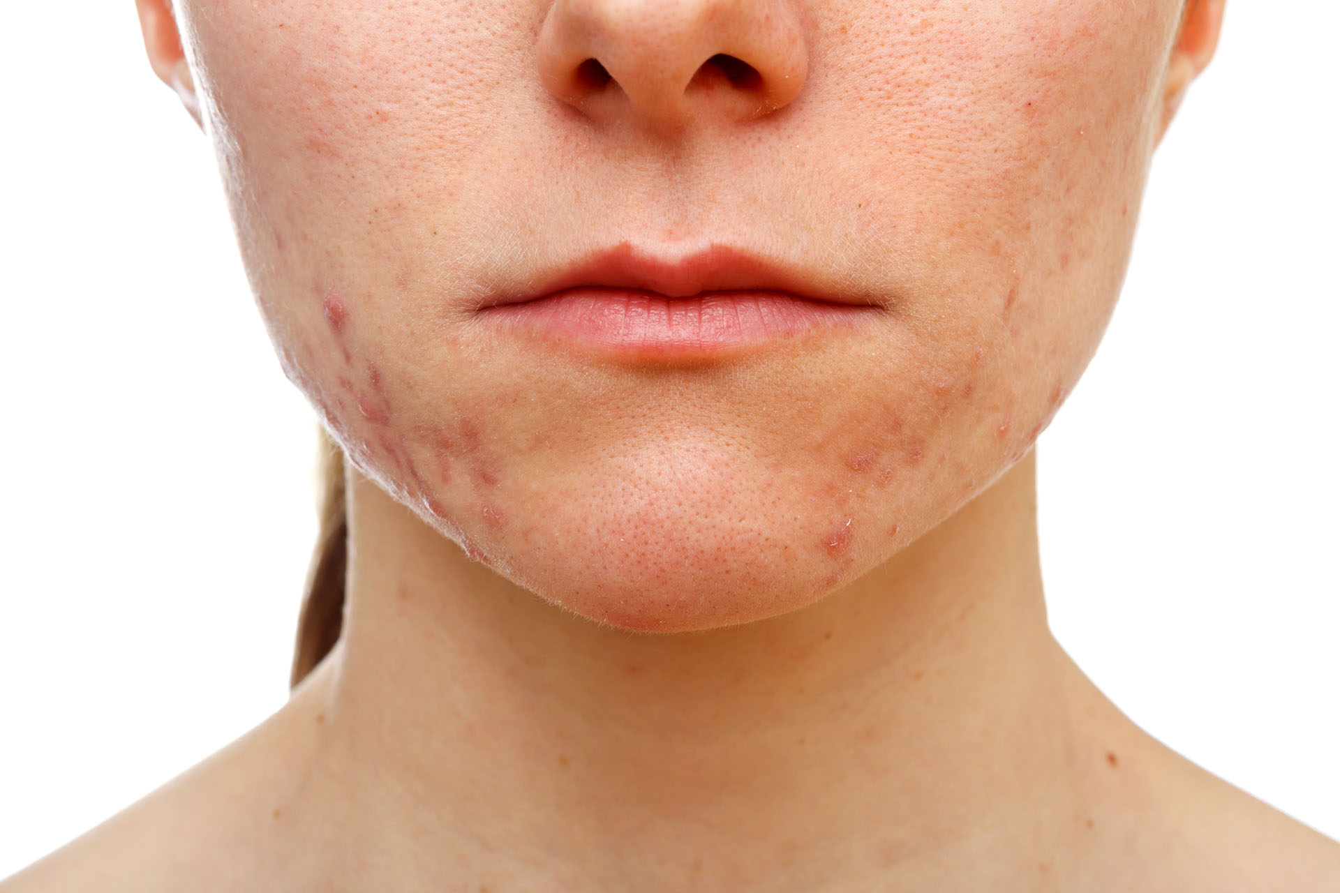 10 Proven Methods That Will Clear the Spots on Your Face Click