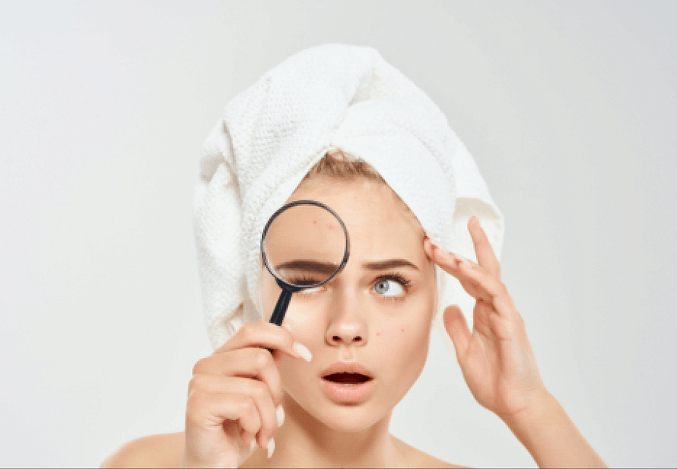 Acne Treatment